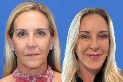 Vertical Restore® / Facial Rejuvenation Before & After Gallery - Patient 283120 - Image 1