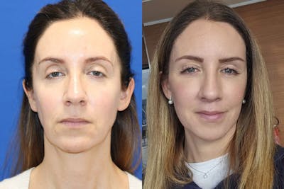 Vertical Restore® / Facial Rejuvenation Before & After Gallery - Patient 263098 - Image 1