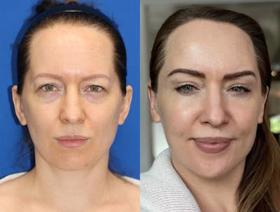 Vertical Restore® / Facial Rejuvenation Before & After Gallery - Patient 187074 - Image 1