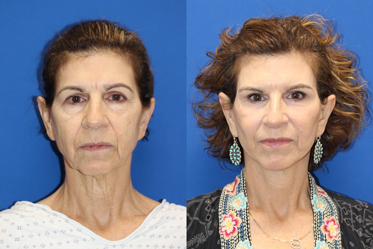 Vertical Restore® / Facial Rejuvenation Before & After Gallery - Patient 290290 - Image 1