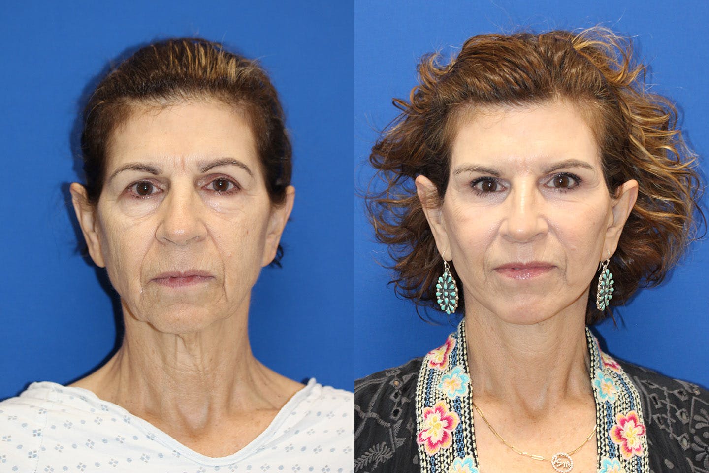 Vertical Restore® / Facial Rejuvenation Before & After Gallery - Patient 414216 - Image 1