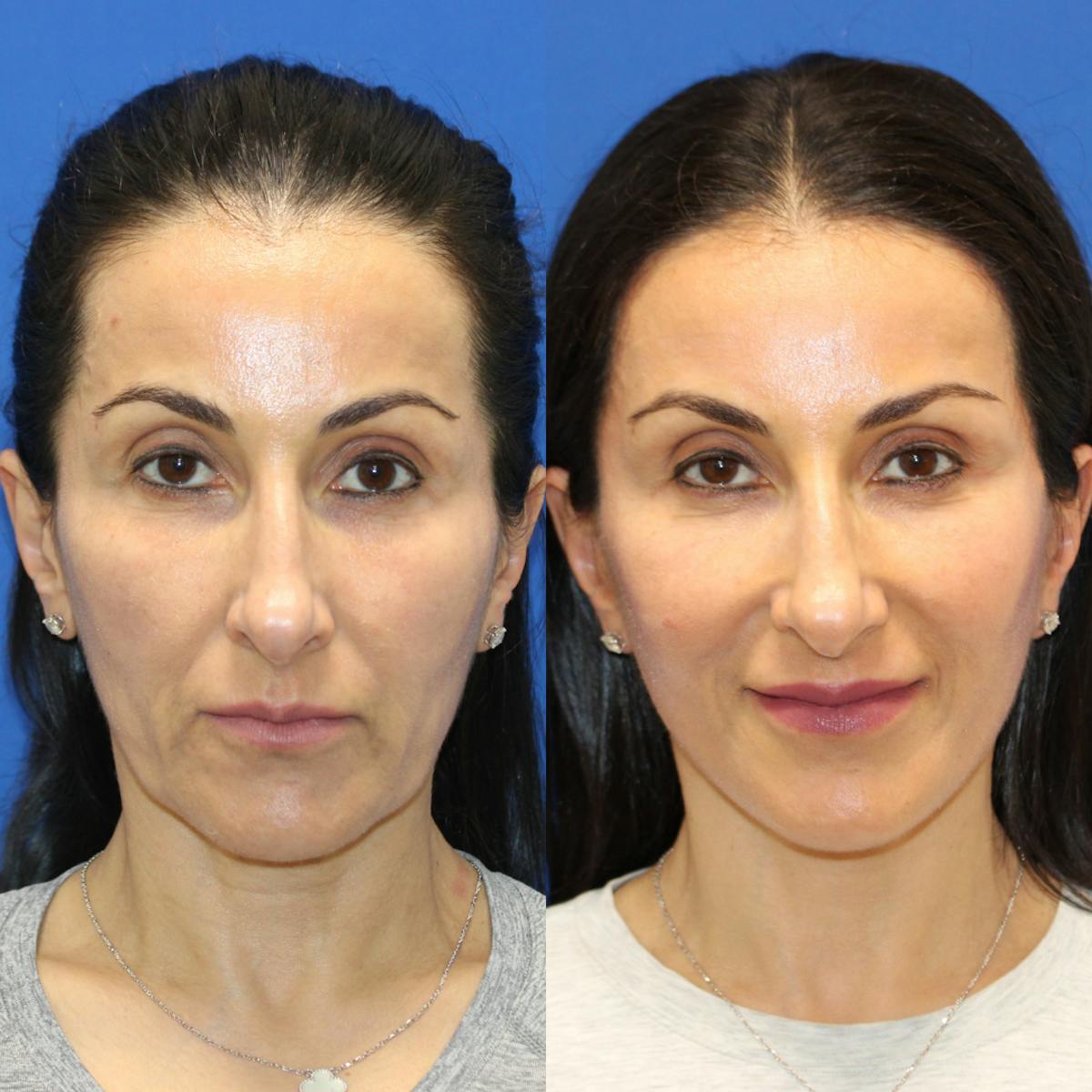 Vertical Restore® / Facial Rejuvenation Before & After Gallery - Patient 145535 - Image 1