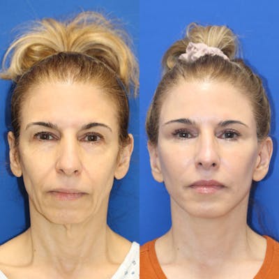 Vertical Restore® / Facial Rejuvenation Before & After Gallery - Patient 312764 - Image 1