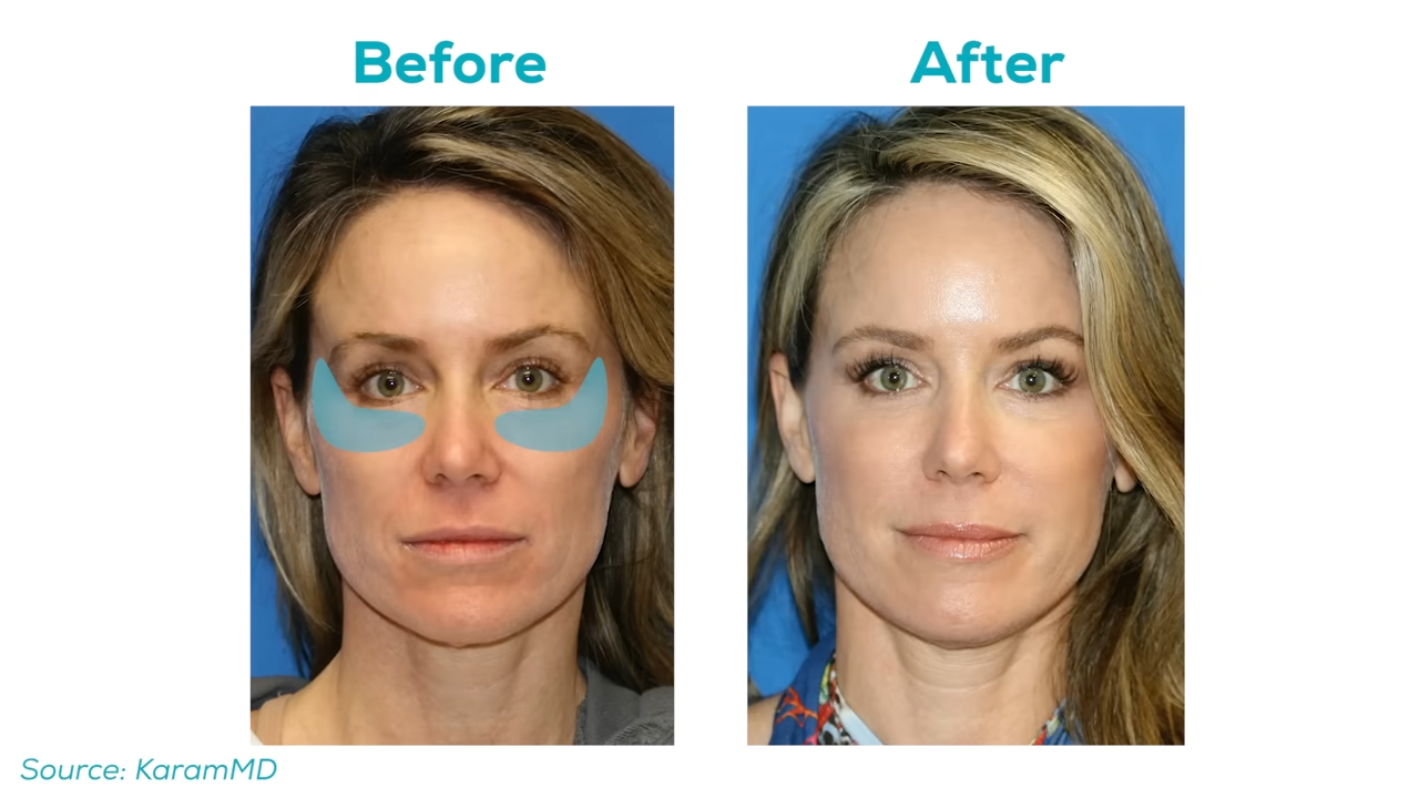 Before & After
