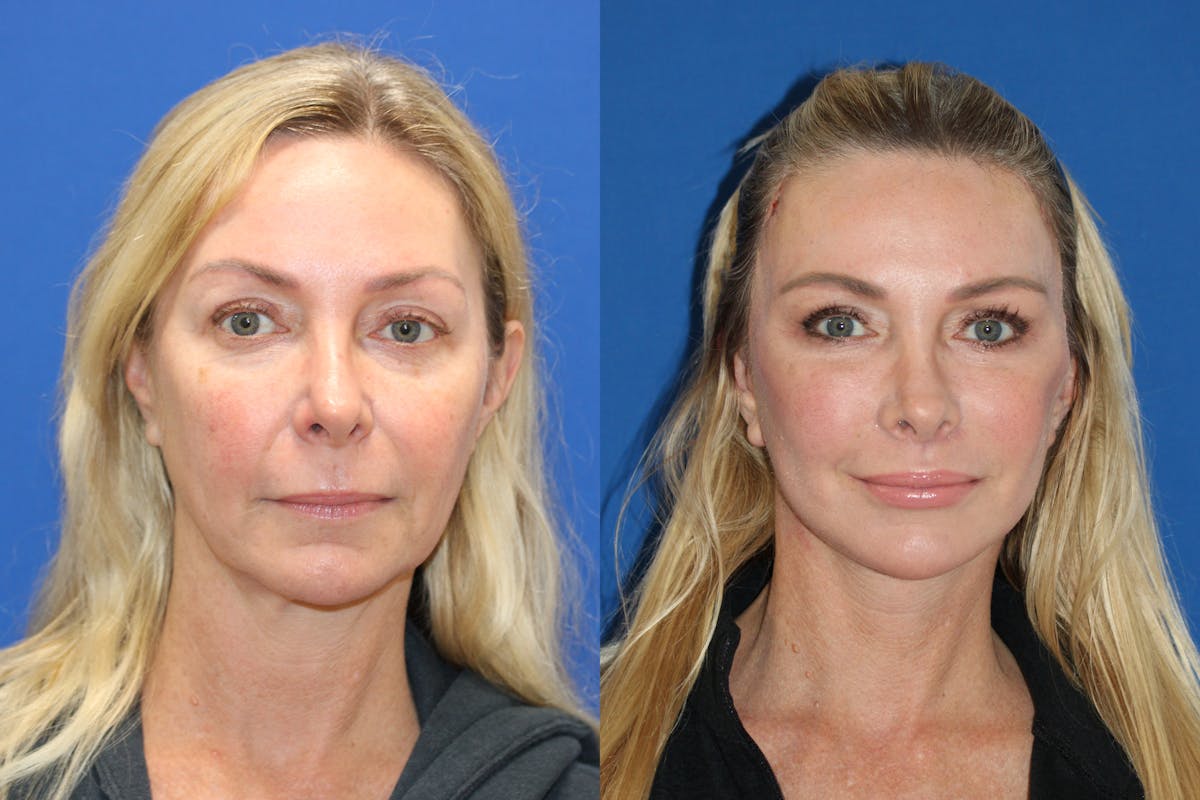 Vertical Restore® / Facial Rejuvenation Before & After Gallery - Patient 301776 - Image 1