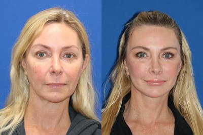 Vertical Restore® / Facial Rejuvenation Before & After Gallery - Patient 301776 - Image 1