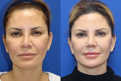 Vertical Restore® / Facial Rejuvenation Before & After Gallery - Patient 147184 - Image 1