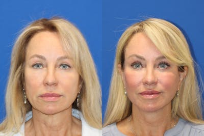 Vertical Restore® / Facial Rejuvenation Before & After Gallery - Patient 283761 - Image 1
