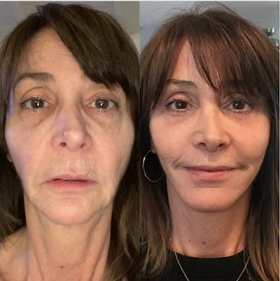 Vertical Restore® / Facial Rejuvenation Before & After Gallery - Patient 348093 - Image 1