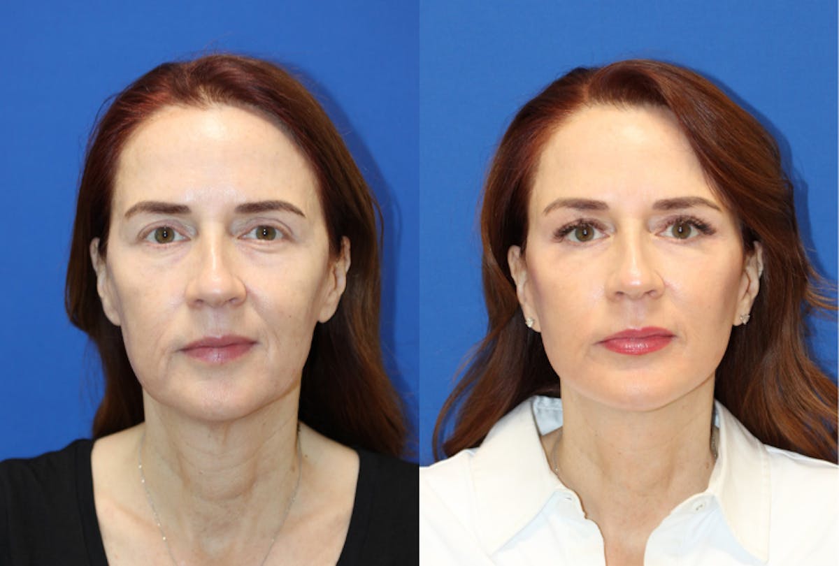 Vertical Restore® / Facial Rejuvenation Before & After Gallery - Patient 123452 - Image 1