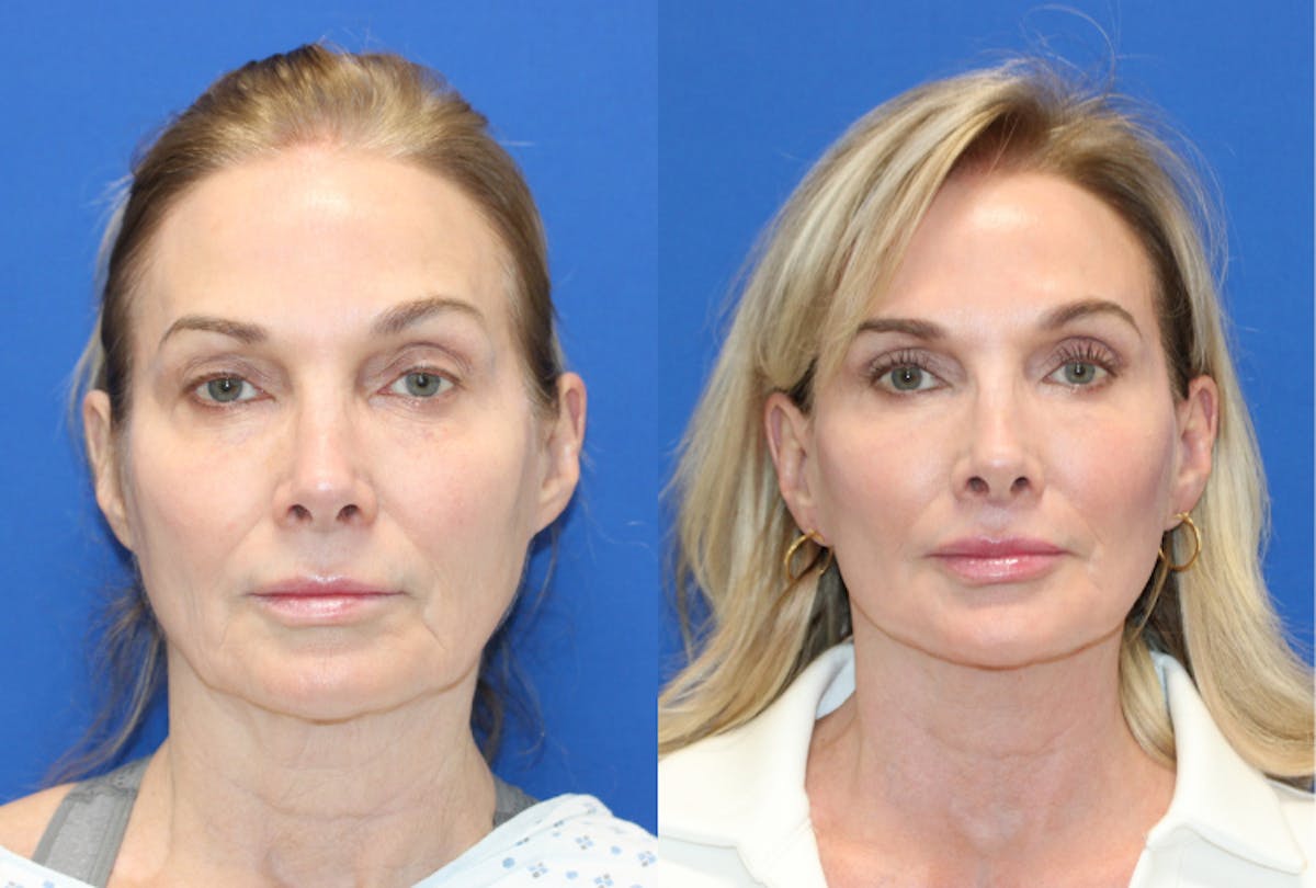 Vertical Restore® / Facial Rejuvenation Before & After Gallery - Patient 834367 - Image 1
