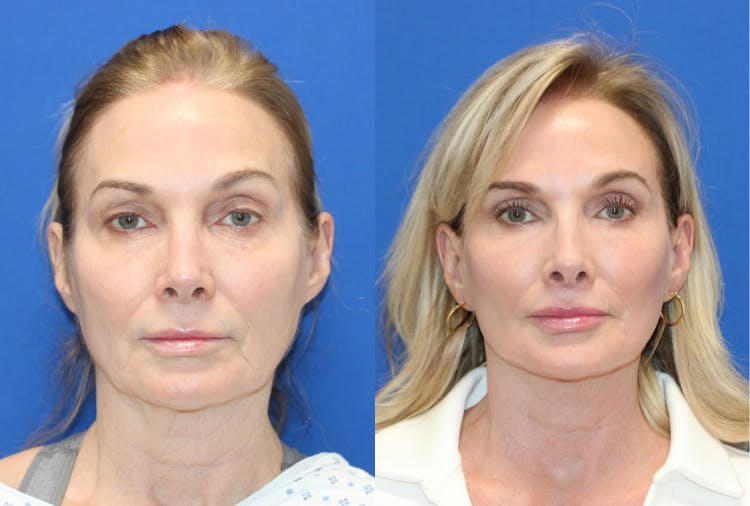 Vertical Restore® / Facial Rejuvenation Before & After Gallery - Patient 341311 - Image 1
