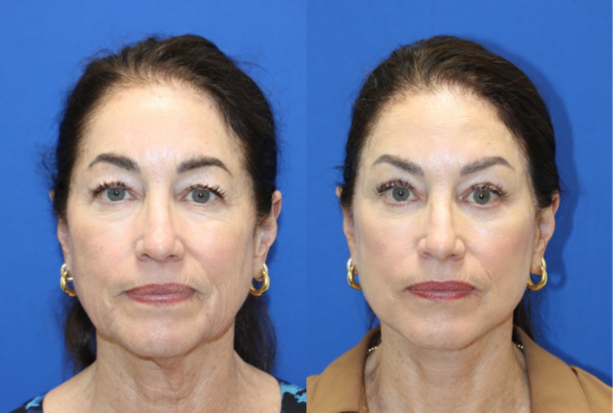 Vertical Restore® / Facial Rejuvenation Before & After Gallery - Patient 272326 - Image 1