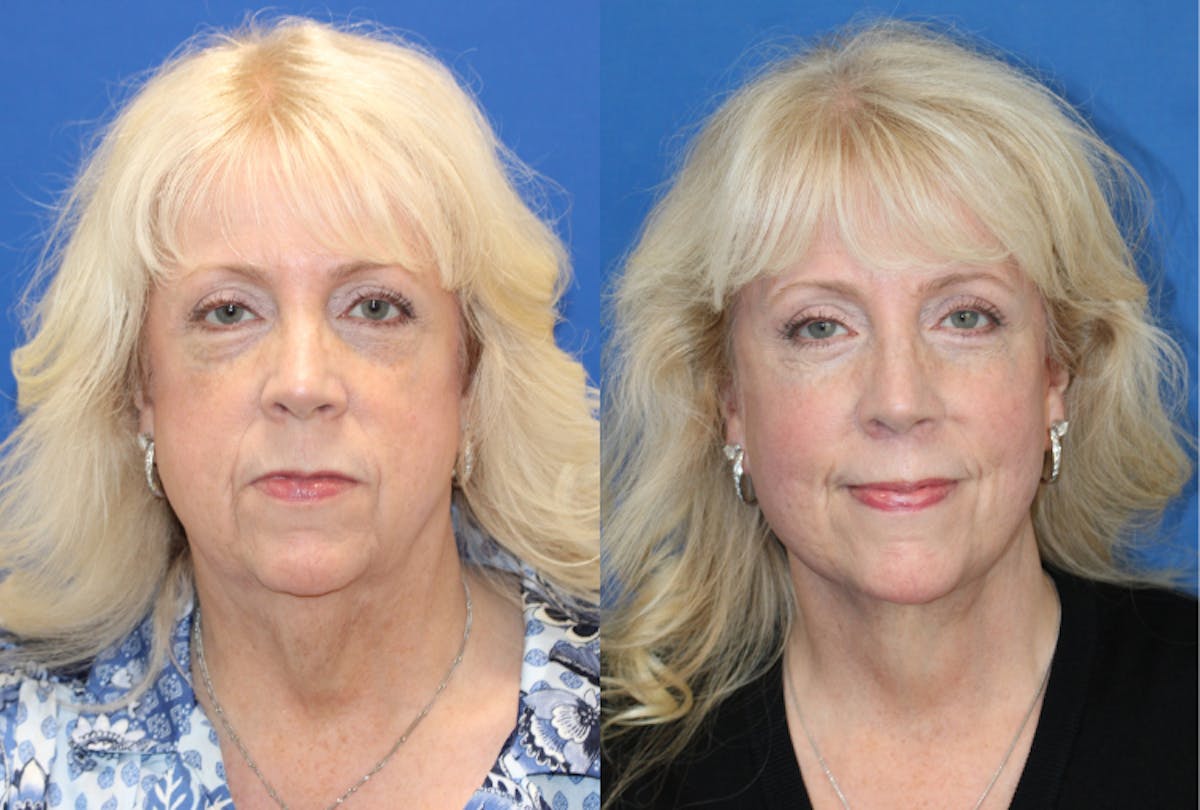 Vertical Restore® / Facial Rejuvenation Before & After Gallery - Patient 392545 - Image 1