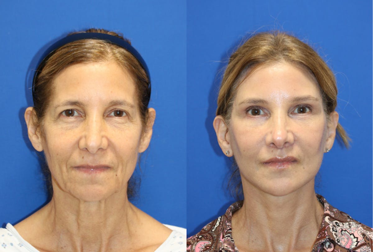 Vertical Restore® / Facial Rejuvenation Before & After Gallery - Patient 395784 - Image 1