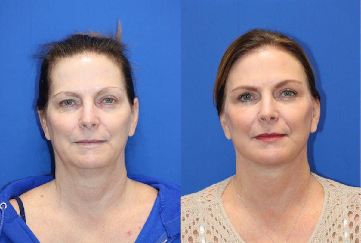 Vertical Restore® / Facial Rejuvenation Before & After Gallery - Patient 422130 - Image 1