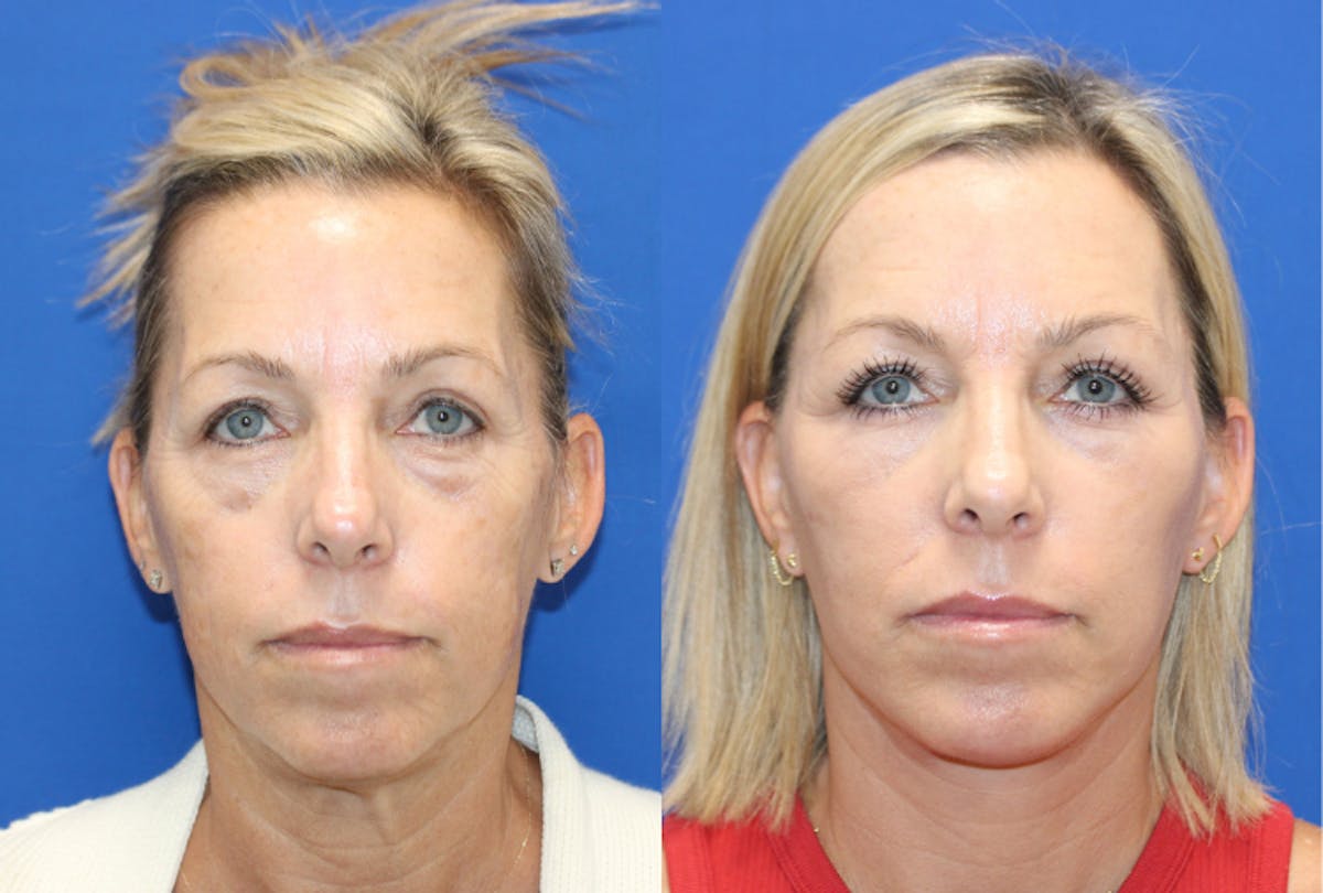 Vertical Restore® / Facial Rejuvenation Before & After Gallery - Patient 168393 - Image 1