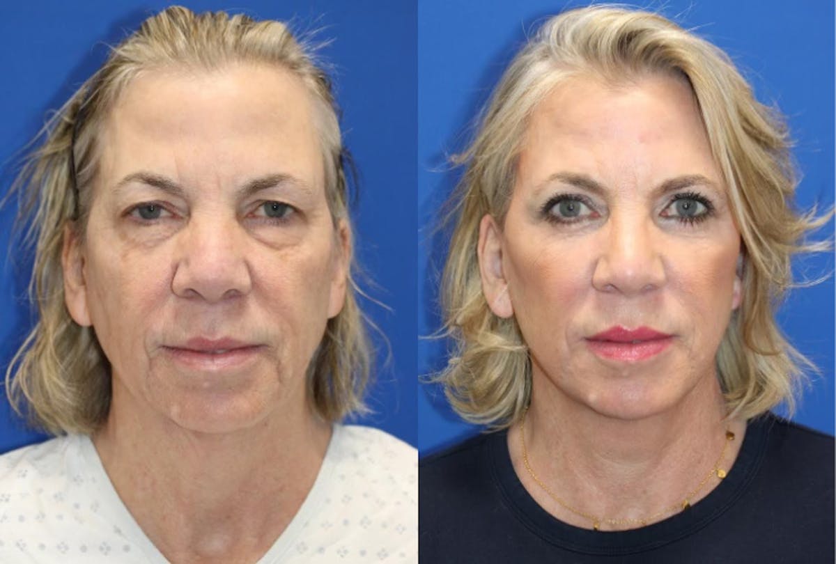 Vertical Restore® / Facial Rejuvenation Before & After Gallery - Patient 284159 - Image 1