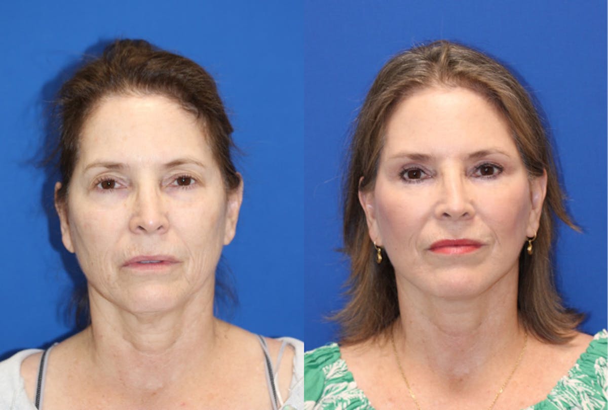 Vertical Restore® / Facial Rejuvenation Before & After Gallery - Patient 366301 - Image 1