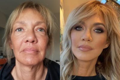 Vertical Restore® / Facial Rejuvenation Before & After Gallery - Patient 264519 - Image 1