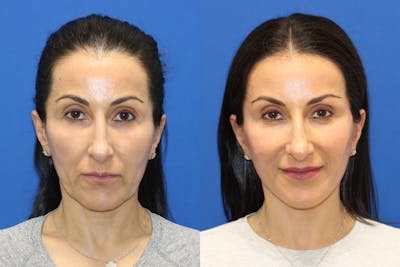 Vertical Restore® / Facial Rejuvenation Before & After Gallery - Patient 145535 - Image 1