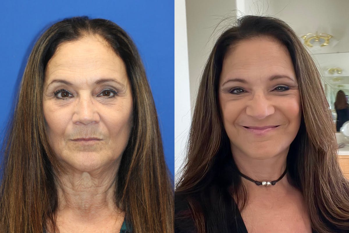 Vertical Restore® / Facial Rejuvenation Before & After Gallery - Patient 290290 - Image 1