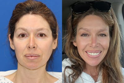 Vertical Restore® / Facial Rejuvenation Before & After Gallery - Patient 283761 - Image 1