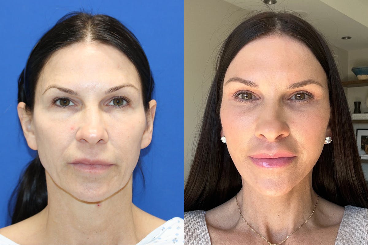Vertical Restore® / Facial Rejuvenation Before & After Gallery - Patient 834367 - Image 1
