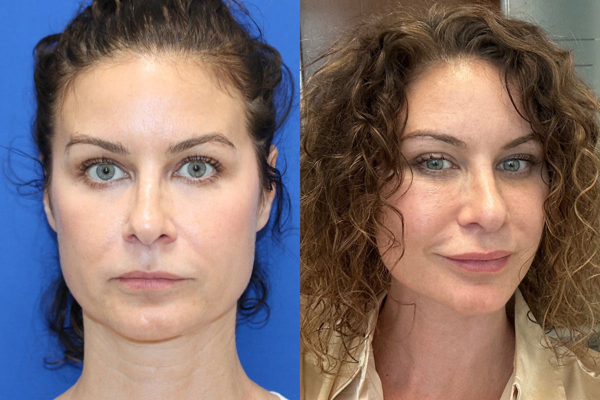 Vertical Restore® / Facial Rejuvenation Before & After Gallery - Patient 755306 - Image 1