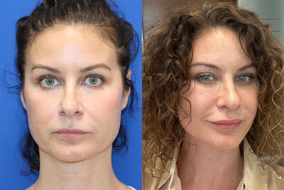 Vertical Restore® / Facial Rejuvenation Before & After Gallery - Patient 755306 - Image 1