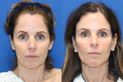 Vertical Restore® / Facial Rejuvenation Before & After Gallery - Patient 233203 - Image 1