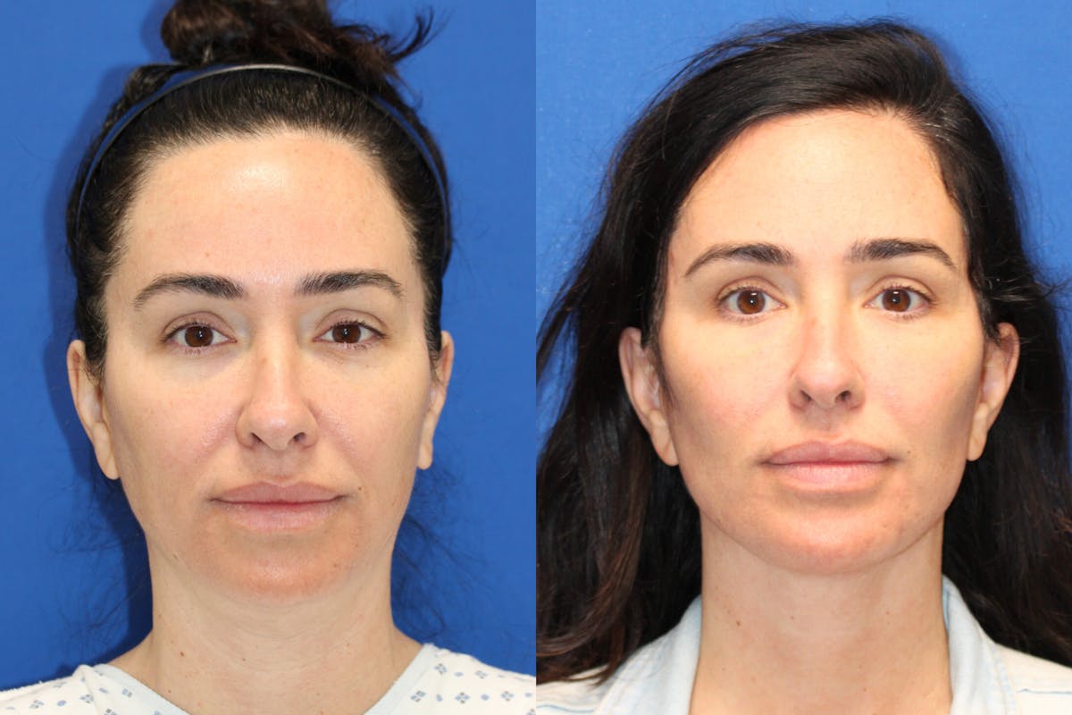 Vertical Restore® / Facial Rejuvenation Before & After Gallery - Patient 199030 - Image 1