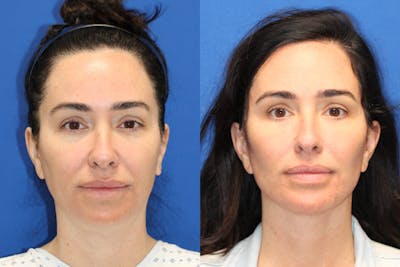 Vertical Restore® / Facial Rejuvenation Before & After Gallery - Patient 199030 - Image 1