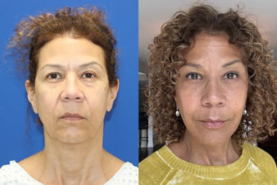 Vertical Restore® / Facial Rejuvenation Before & After Gallery - Patient 689744 - Image 1