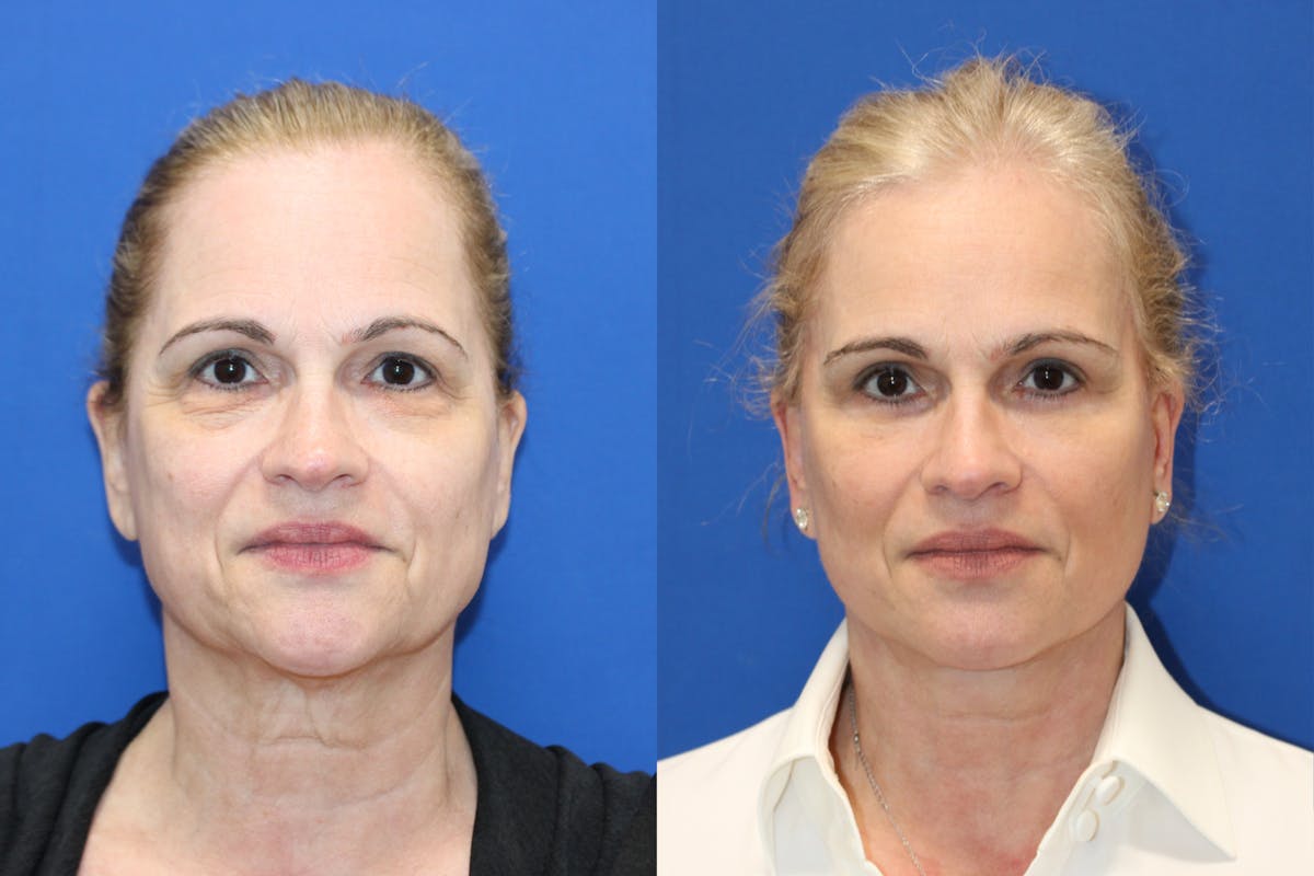 Vertical Restore® / Facial Rejuvenation Before & After Gallery - Patient 869642 - Image 1