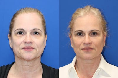 Vertical Restore® / Facial Rejuvenation Before & After Gallery - Patient 869642 - Image 1