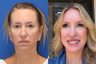 Vertical Restore® / Facial Rejuvenation Before & After Gallery - Patient 307080 - Image 1