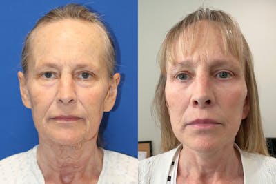 Vertical Restore® / Facial Rejuvenation Before & After Gallery - Patient 125356 - Image 1