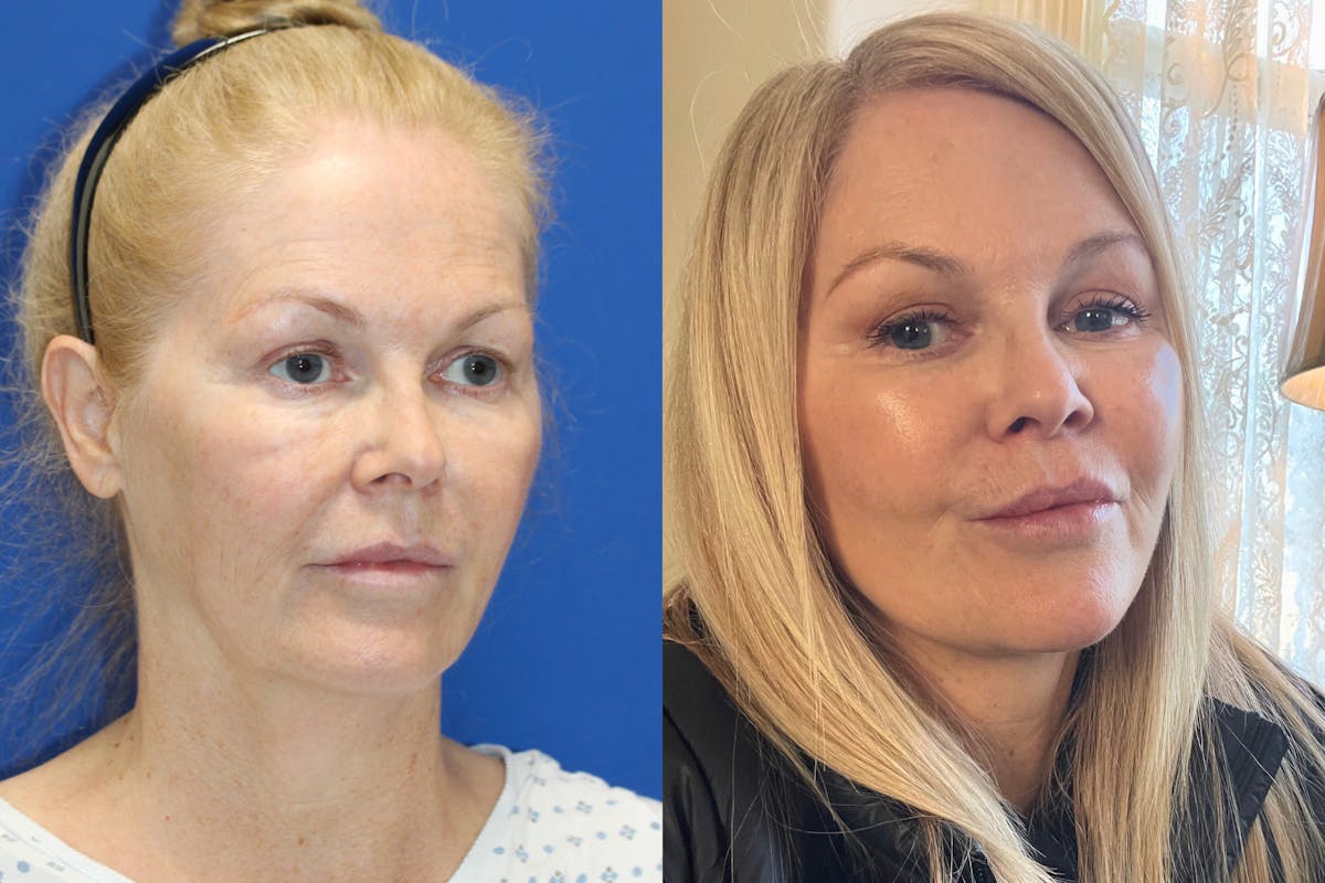 Vertical Restore® / Facial Rejuvenation Before & After Gallery - Patient 252695 - Image 1