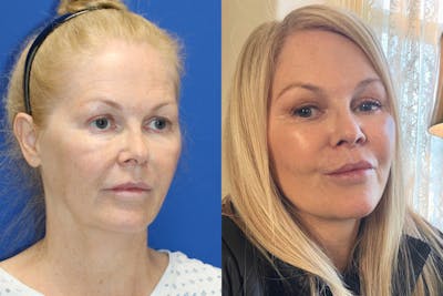 Vertical Restore® / Facial Rejuvenation Before & After Gallery - Patient 252695 - Image 1