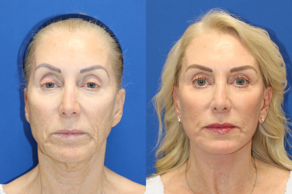 Vertical Restore® / Facial Rejuvenation Before & After Gallery - Patient 914685 - Image 1