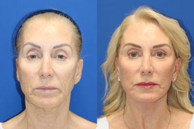 Vertical Restore® / Facial Rejuvenation Before & After Gallery - Patient 914685 - Image 1