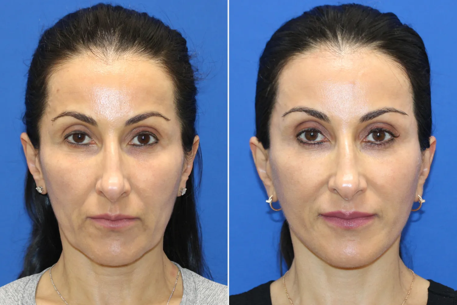 Neda Before and After Vertical Restore