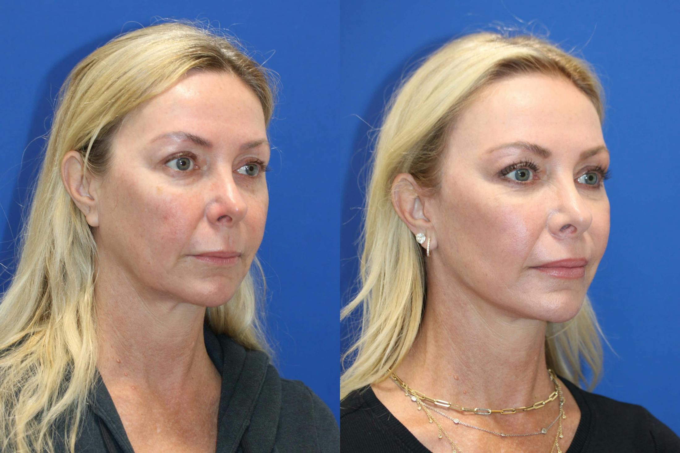 Vertical Restore® / Facial Rejuvenation Before & After Gallery - Patient 301776 - Image 2