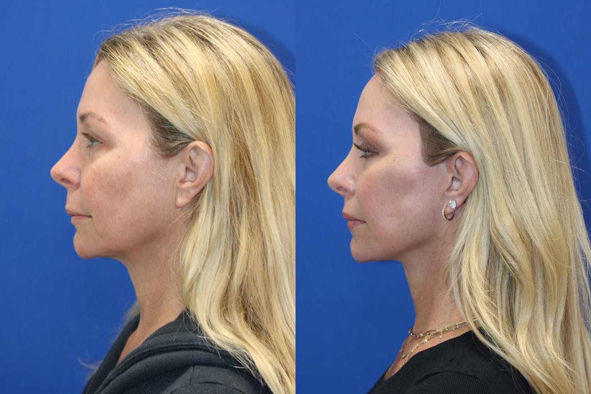 Vertical Restore® / Facial Rejuvenation Before & After Gallery - Patient 301776 - Image 4