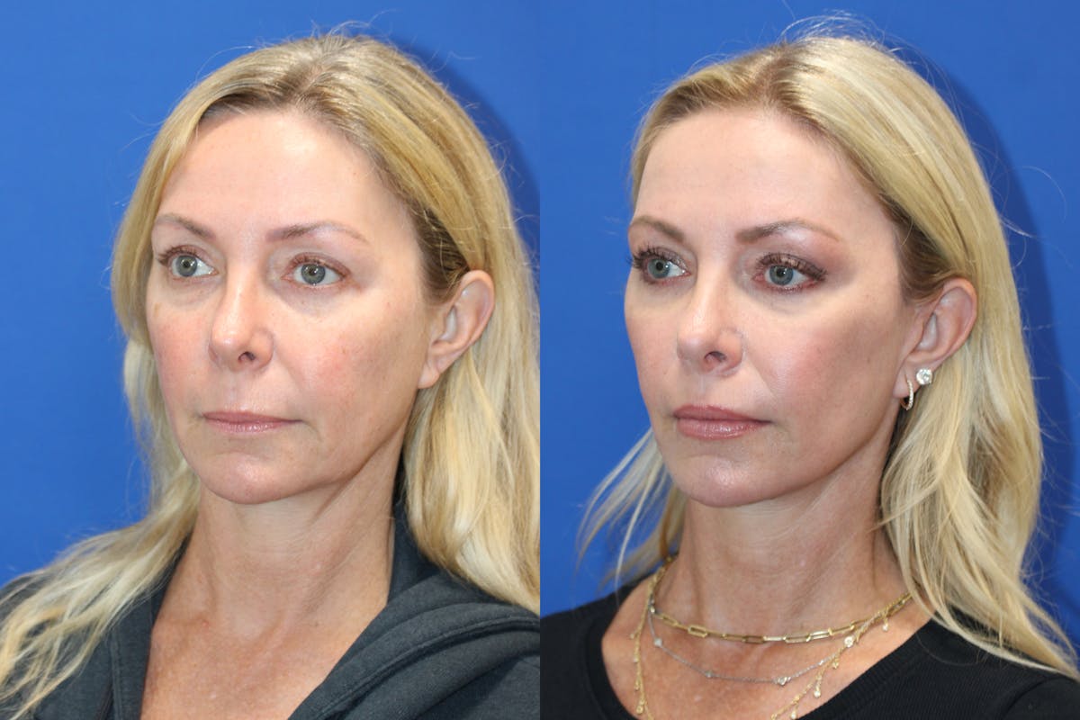 Vertical Restore® / Facial Rejuvenation Before & After Gallery - Patient 301776 - Image 3