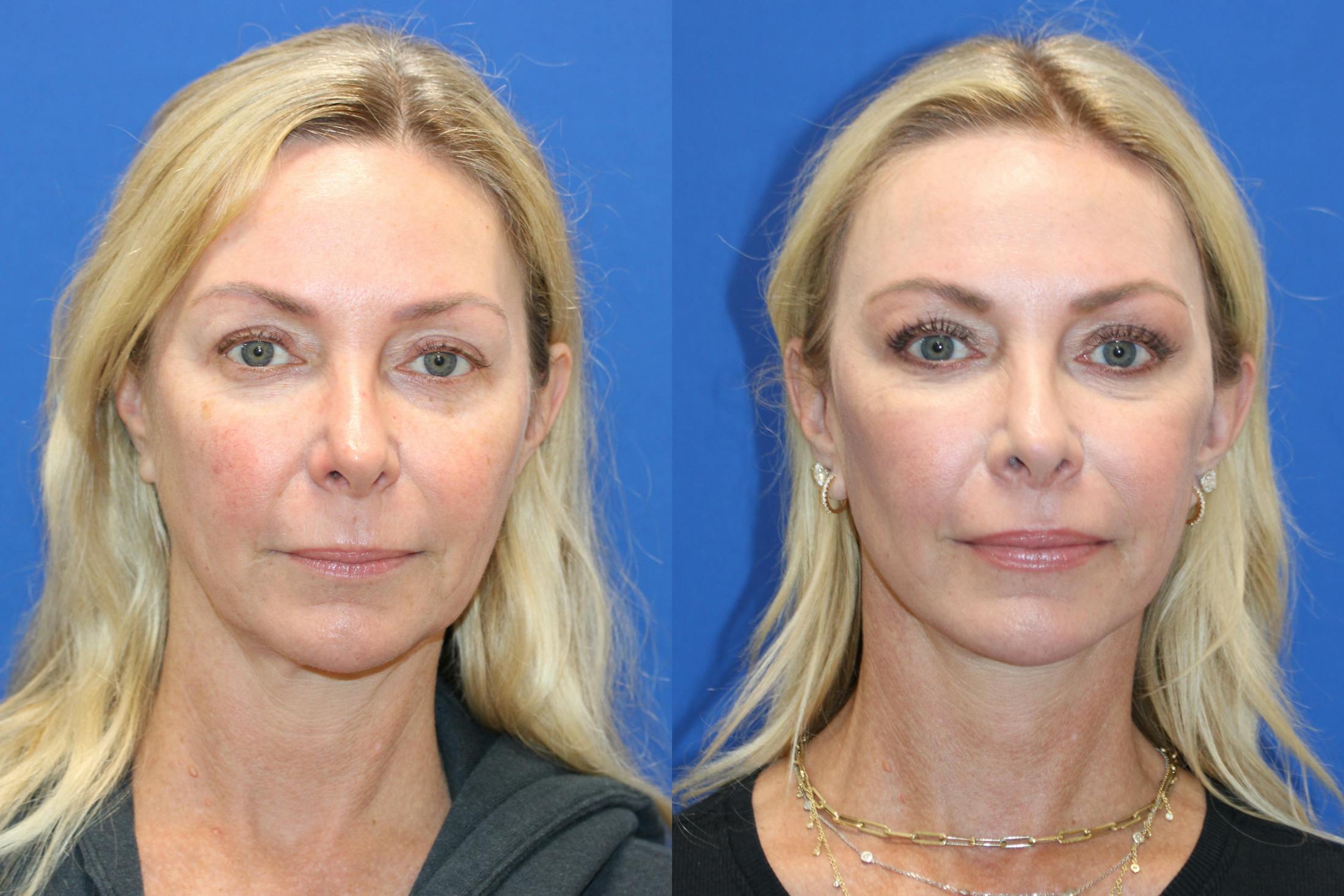 Vertical Restore® / Facial Rejuvenation Before & After Gallery - Patient 301776 - Image 1