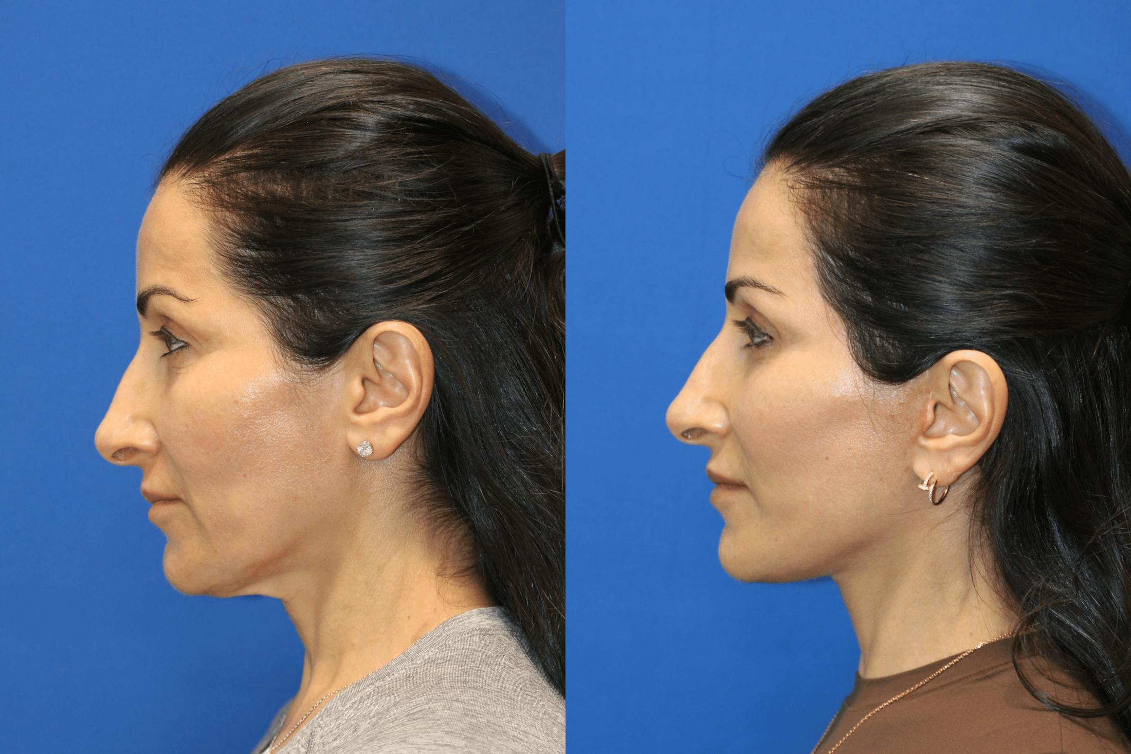 Vertical Restore® / Facial Rejuvenation Before & After Gallery - Patient 145535 - Image 5