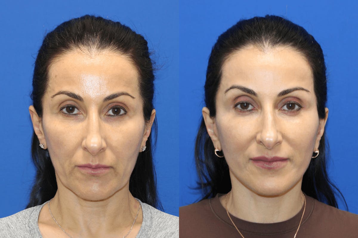 Vertical Restore® / Facial Rejuvenation Before & After Gallery - Patient 145535 - Image 6