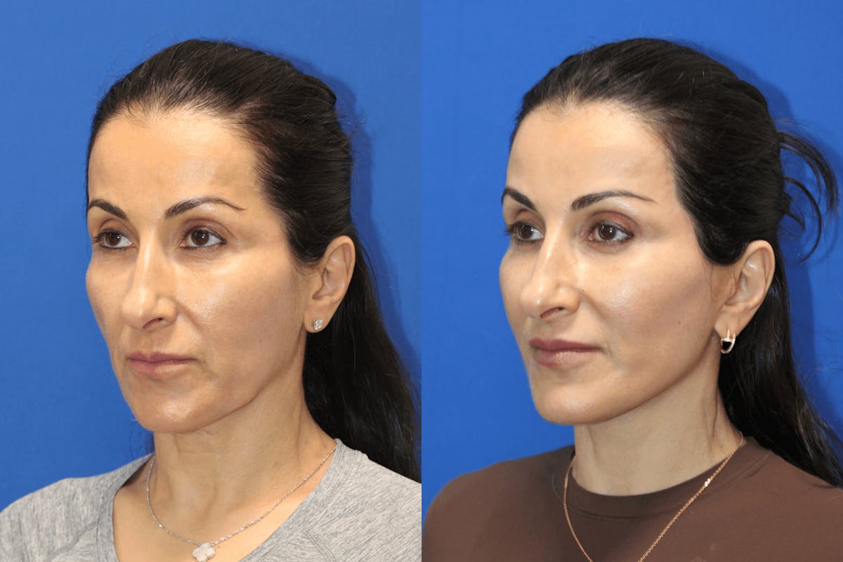 Vertical Restore® / Facial Rejuvenation Before & After Gallery - Patient 145535 - Image 4